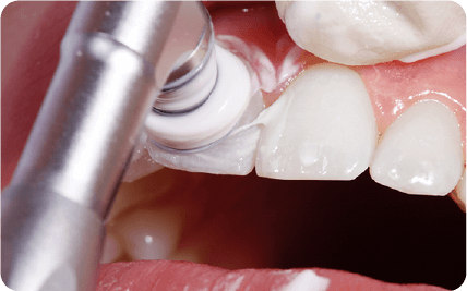 歯のクリーニングPMTC