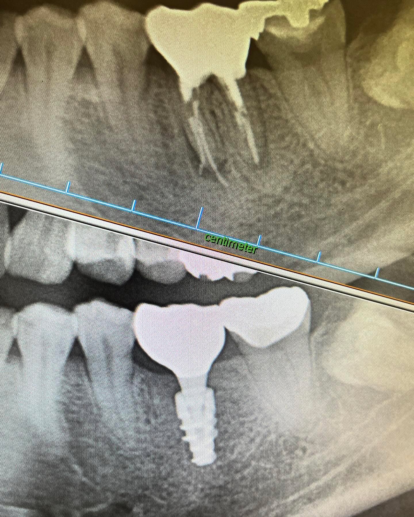 こんにちはこちらは左下奥歯のインプラント症例写真です🦷上のお写真では2本の歯根の一本がパックリと割れているのが確認できます。これは歯根破折と呼ばれ、基本的には根本治療がなく抜歯対象となります。腫れを繰り返したり、硬いものが噛めないという症状が続きます長期間放置すると歯根の周囲の健康な骨が少しずつ溶けてしまいます。患者さまと何度かご相談のお時間をとり隣の歯を削るブリッジではなく、人工歯根（インプラント）で治療を進めました。噛み合わせが強い方でしたが、今ではしっかりと奥歯で何でも噛めますと仰っておりました🤗お口のお悩みがあればお気軽にご相談ください#インプラント#成人矯正#クローバーデンタルオフィス新宿 #歯医者 #歯科医院#インビザライン#矯正歯科#矯正#マウスピース矯正#新大久保#新宿#大人の矯正#矯正女子#ホワイトニング#牙医#implant#invisalign #smile#笑顔#歯並び#teeth#tokyo#東京#虫歯#審美歯科#白い歯#セラミック