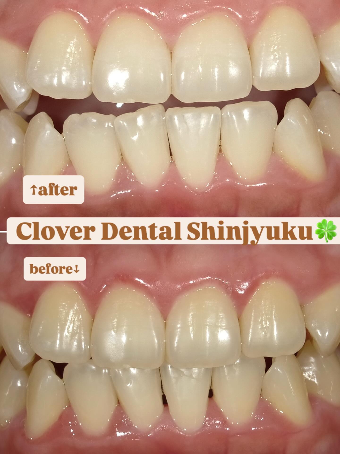 こんにちは秋も深まり過ごしやすい季節になりましたね皆さんは歯医者さんでホワイトニングの施術を受けたことはありますか??歯医者さんでのホワイトニングはオフィスホワイトニングといい、セルフホワイトニングでは取扱い不可の高濃度の過酸化水素を使用しますので短時間で歯を白くします。また薬剤の成分が色味の原因物質を分解してトーンアップするのですが、それにより歯のエナメル質が弱まるということはありません。歯に汚れが付着していると薬剤の効果が減ってしまうので、クリーニング後にホワイトニングをするのが効果的ですどれくらい白くなりますか?という質問をよく聞かれますが、個人差はありますが3回ほど繰り返して頂けると目に見えて白さを実感しやすいです。こちらの症例はオフィスホワイトニングを3回施術後になります。当院では初回税込7980円でお試しでき、一ヶ月の間であれば何回でも同じ金額でホワイトニング可能です歯の色が気になる方、ぜひご予約お待ちしております!口元が明るくなると笑顔も輝きます#オフィスホワイトニング #成人矯正#クローバーデンタルオフィス新宿 #歯医者 #歯科医院#インビザライン#矯正歯科#矯正#マウスピース矯正#新大久保#新宿#大人の矯正#矯正女子#ホワイトニング#牙医#女医#invisalign #smile#歯並び#teeth#日曜診療 #東京#審美歯科#白い歯#whitening#ジルコニア#セラミック#虫歯#歯ブラシ#牙齿美白