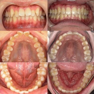こんにちは😃

本日はインビザラインの症例をご紹介します❕

左側が初診時、右側が矯正後になります🍀
治療期間は約2年半でした🤗

患者様も歯並びや噛み合わせに満足して頂けたようで、今後は後戻り防止のリテーナーを作成予定です🦷💫🦷💫🦷💫

笑顔から見える大切なお口や歯をケア出来ていますでしょうか？
もちろん歯並びもお気軽にご相談ください！

#成人矯正#クローバーデンタルオフィス新宿 #歯医者 #歯科医院#インビザライン#矯正歯科#矯正#マウスピース矯正#新大久保#新宿#大人の矯正#矯正女子#ホワイトニング#牙医#女医#invisalign#smile#笑顔#歯並び#teeth#tokyo#東京#リップ#審美歯科#白い歯#whitening#歯列矯正#インビザライン矯正#セラミック#インプラント