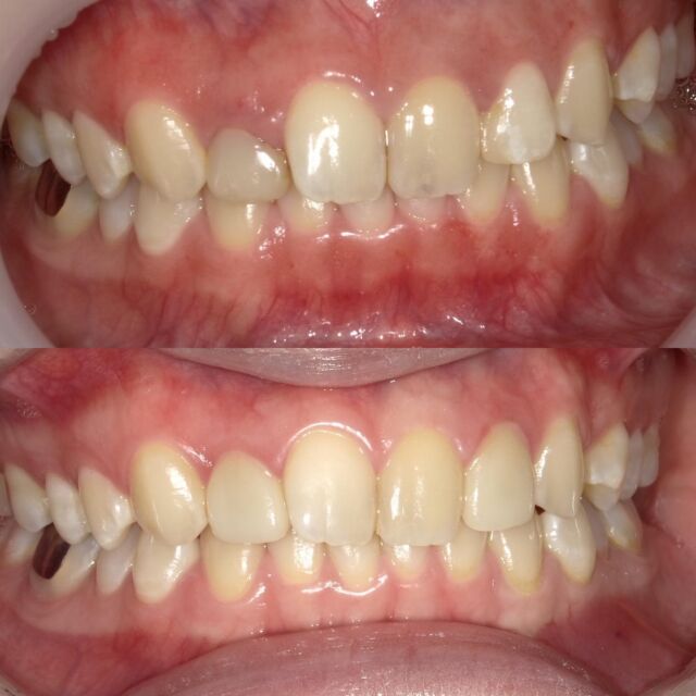 両側の上前歯2番目のオールセラミック症例です🦷
上の写真が初診
下の写真が術後半年後です💫

向かって左側の2番目の歯は歯茎のラインが隣の歯に比べてかなり低かったため、歯槽骨切除と歯肉整形術も行いました。

向かって右の上前歯1番目は噛み合わせにより先端のエナメル質がすり減って、
暗く見えるためコンポジットレジンにて表面に厚みを加えました🤗

#成人矯正#クローバーデンタルオフィス新宿 #歯医者 #歯科医院#インビザライン#矯正歯科#矯正#マウスピース矯正#新大久保#新宿#大人の矯正#矯正女子#ホワイトニング#牙医#女医#invisalign#smile#笑顔#歯並び#teeth#tokyo#東京#リップ#審美歯科#白い歯#whitening#歯列矯正#インビザライン矯正#セラミック#インプラント