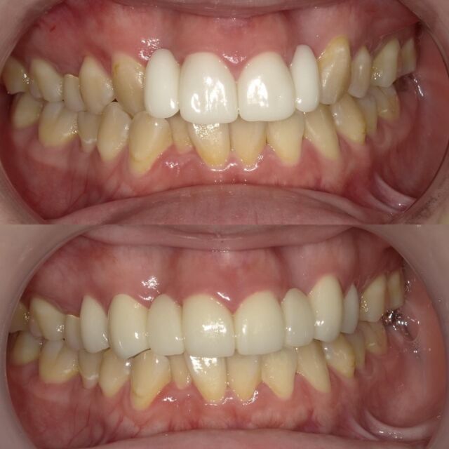 こんにちは😃
今回は前歯の補綴症例写真です↑

こちらの患者さまは
上の左右二番目の前歯がもともと欠損していて、他院で4本のつながったジルコニアがセットされておりました。
上が初診時の写真です。

下が当院で8本のジルコニアで修復した術後写真です✨

歯の形や色味、スマイルラインのバランスが整いとても綺麗なスマイルとなりました！

#成人矯正#クローバーデンタルオフィス新宿 #歯医者 #歯科医院#インビザライン#矯正歯科#矯正#マウスピース矯正#新大久保#新宿#大人の矯正#矯正女子#ホワイトニング#牙医#女医#invisalign#smile#歯科衛生士#歯科助手#歯並び#teeth#東京#ジルコニア#審美歯科#白い歯#whitening#歯列矯正#インビザライン矯正#セラミック#インプラント