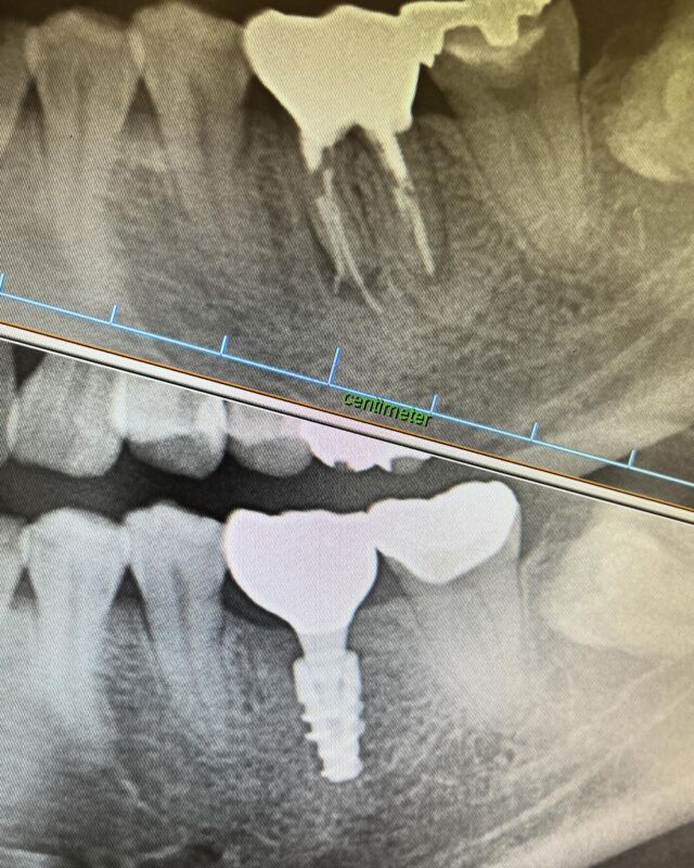 こんにちは😃
こちらは左下奥歯のインプラント症例写真です🦷
上のお写真では2本の歯根の一本がパックリと割れているのが確認できます。
これは歯根破折と呼ばれ、基本的には根本治療がなく抜歯対象となります。
腫れを繰り返したり、硬いものが噛めないという症状が続きます😢長期間放置すると歯根の周囲の健康な骨が少しずつ溶けてしまいます。

患者さまと何度かご相談のお時間をとり隣の歯を削るブリッジではなく、
人工歯根（インプラント）で治療を進めました。

噛み合わせが強い方でしたが、今ではしっかりと奥歯で何でも噛めますと仰っておりました🤗

お口のお悩みがあればお気軽にご相談ください🍀

#インプラント#成人矯正#クローバーデンタルオフィス新宿 #歯医者 #歯科医院#インビザライン#矯正歯科#矯正#マウスピース矯正#新大久保#新宿#大人の矯正#矯正女子#ホワイトニング#牙医#implant#invisalign #smile#笑顔#歯並び#teeth#tokyo#東京#虫歯#審美歯科#白い歯#セラミック