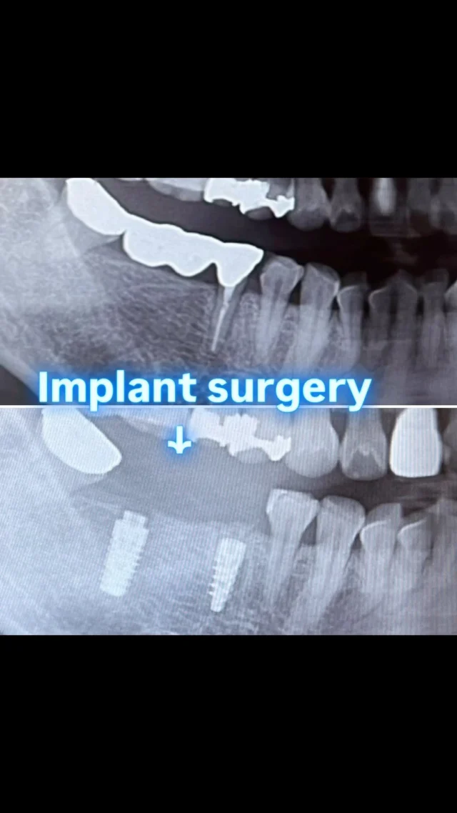 今回はインプラント症例です🦷
右下の4本のブリッジの手前が歯根破折で腫れを繰り返していた患者様です。
インプラントブリッジを予定しています🌈

抜歯と同時にインプラントを埋入しました。
骨とインプラントがしっかり付くのを待ちます😌🍀

#インプラント#成人矯正#クローバーデンタルオフィス新宿 #歯医者 #歯科医院#インビザライン#矯正歯科#矯正#マウスピース矯正#新大久保#新宿#大人の矯正#矯正女子#ホワイトニング#牙医#implant#invisalign #smile#笑顔#歯並び#teeth#tokyo#東京#虫歯#審美歯科#白い歯#セラミック